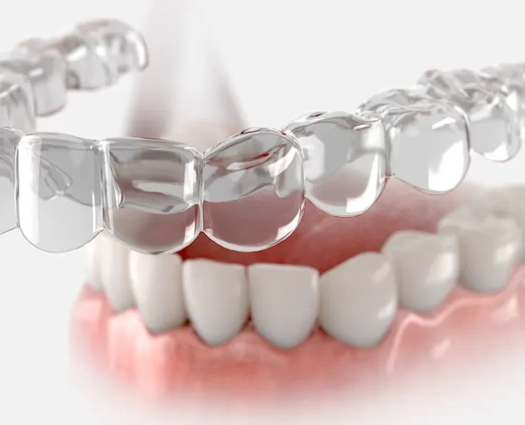 1. invisalign