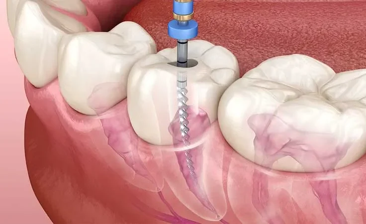 1. root-canal-procedure