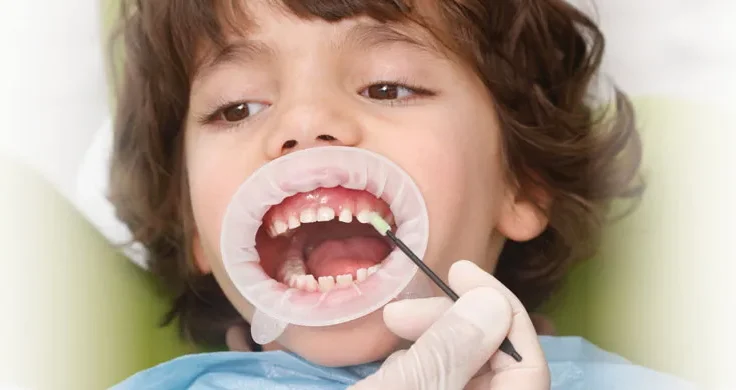 2. floride application