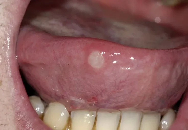 Apthous ulcer