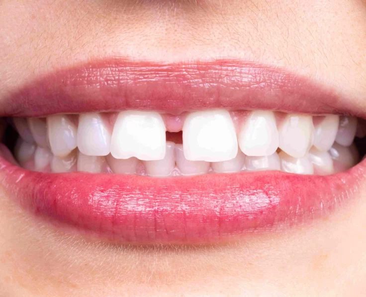 Closing gaps between teeth