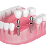 IMPLANT & BRACES IN MOHALI