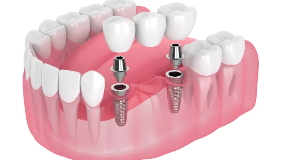 IMPLANT & BRACES IN MOHALI