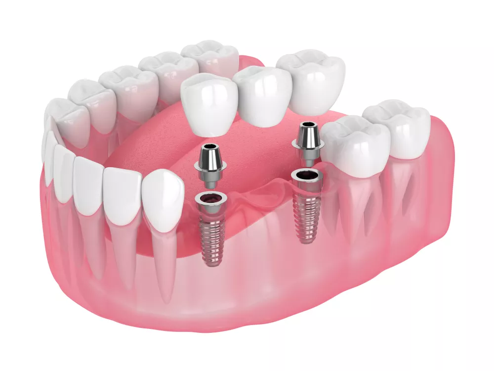 IMPLANT & BRACES IN MOHALI