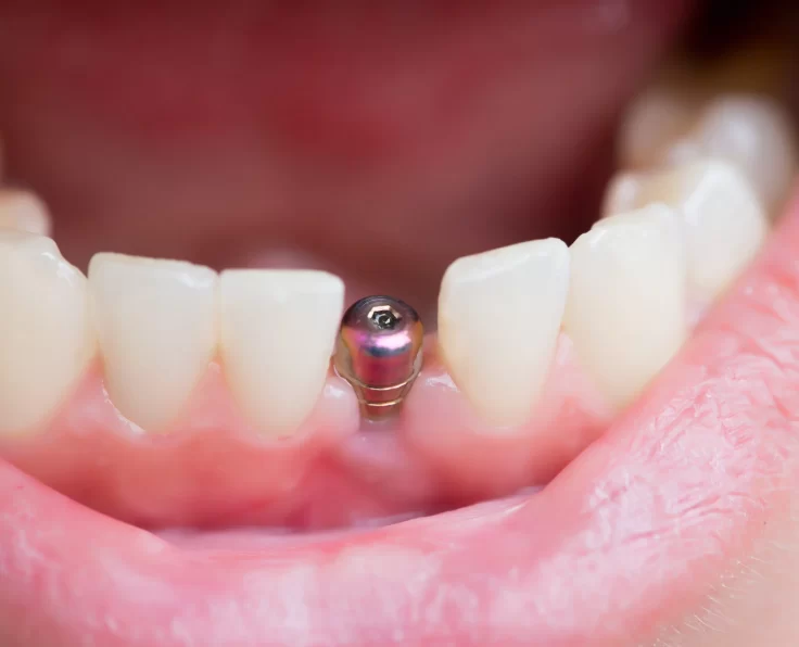 single tooth implant