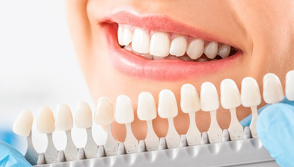 Teeth Whitening